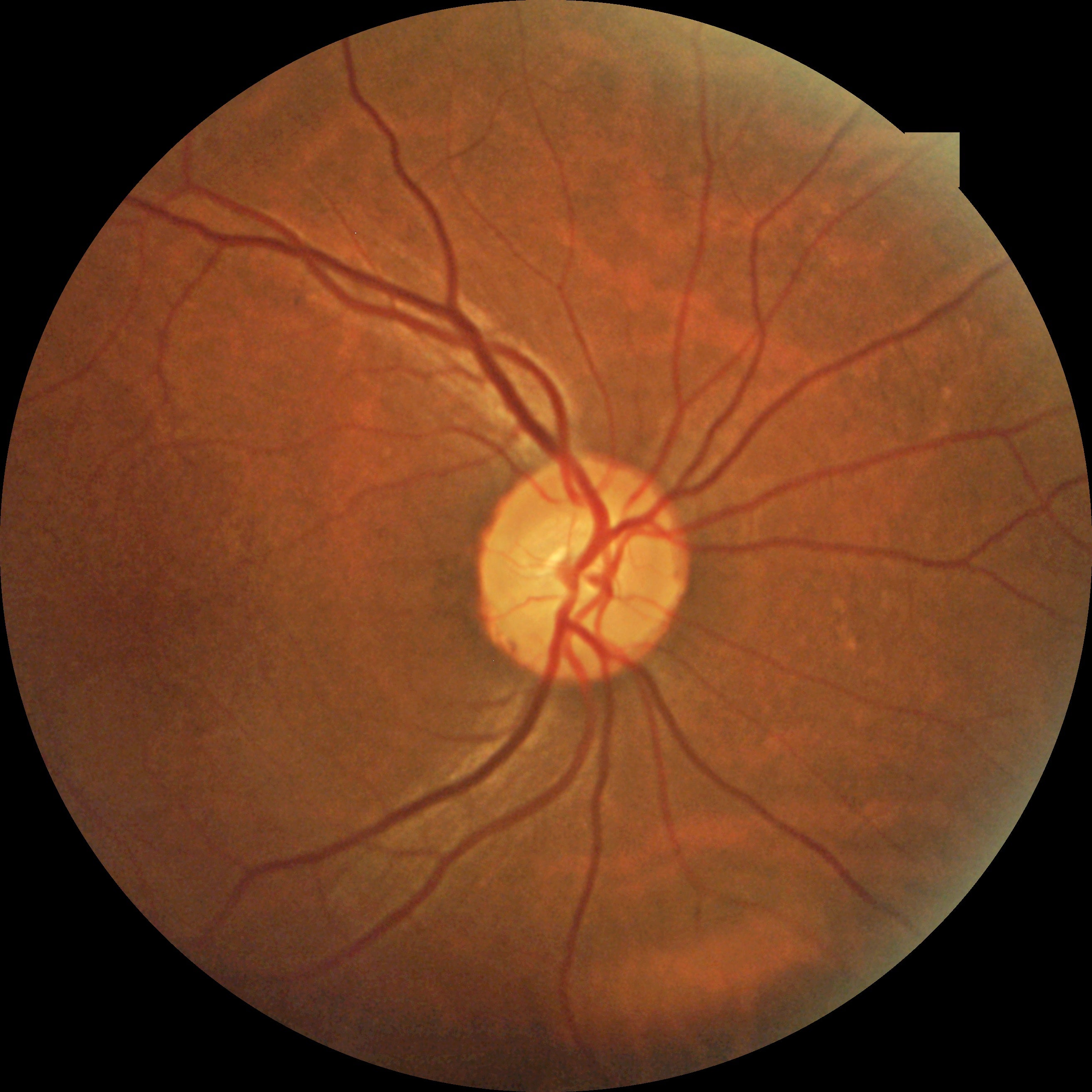 Cámara Retinal No Midriática Portátil Kestrel-300