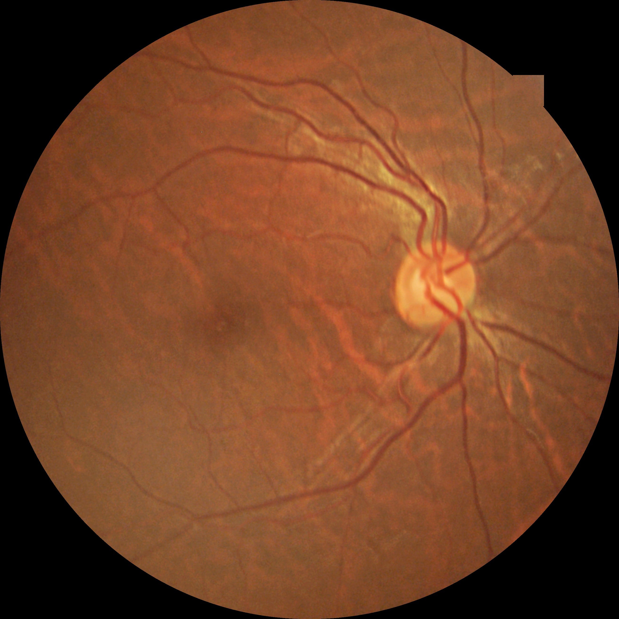 Cámara Retinal No Midriática Portátil Kestrel-300