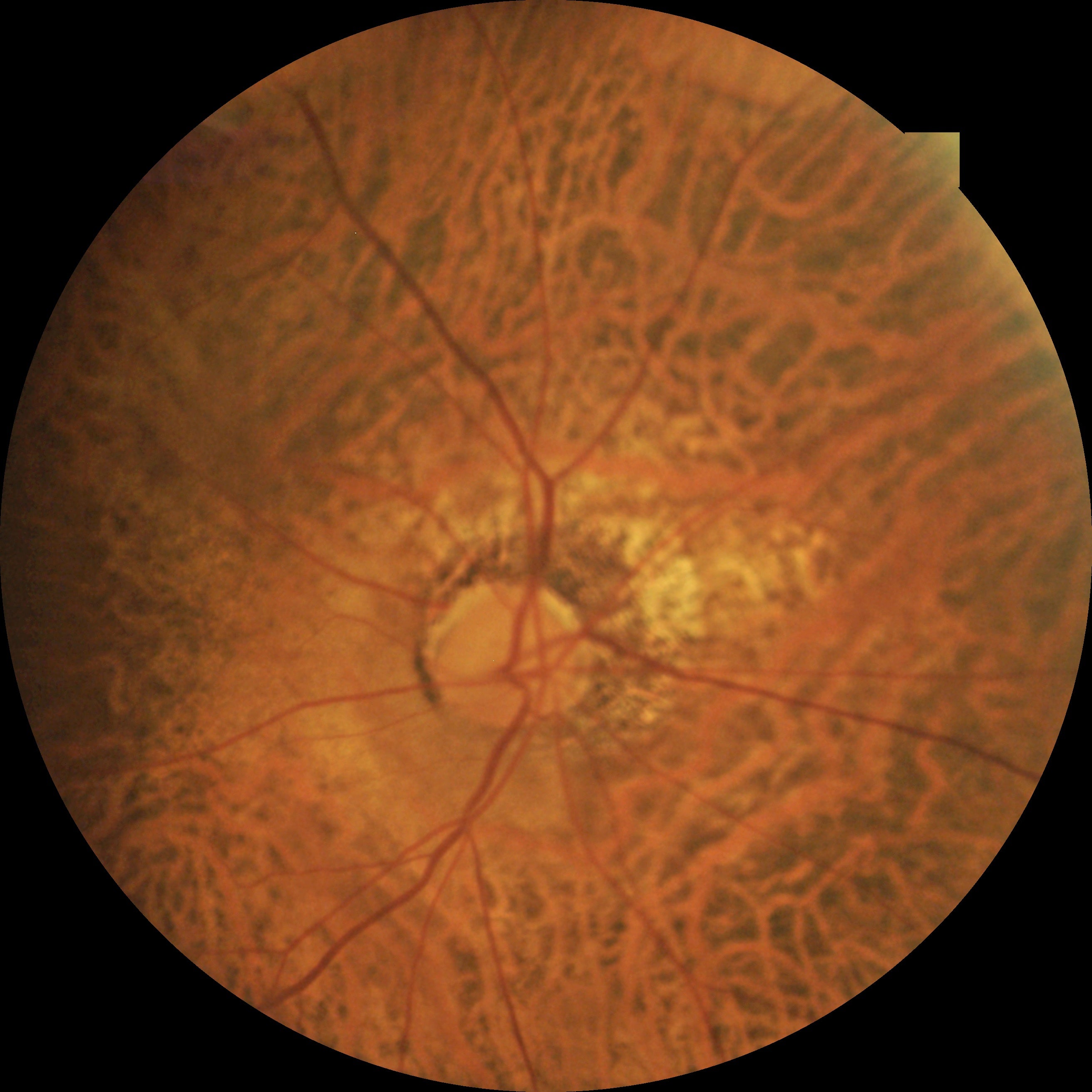 Cámara Retinal No Midriática Portátil Kestrel-300