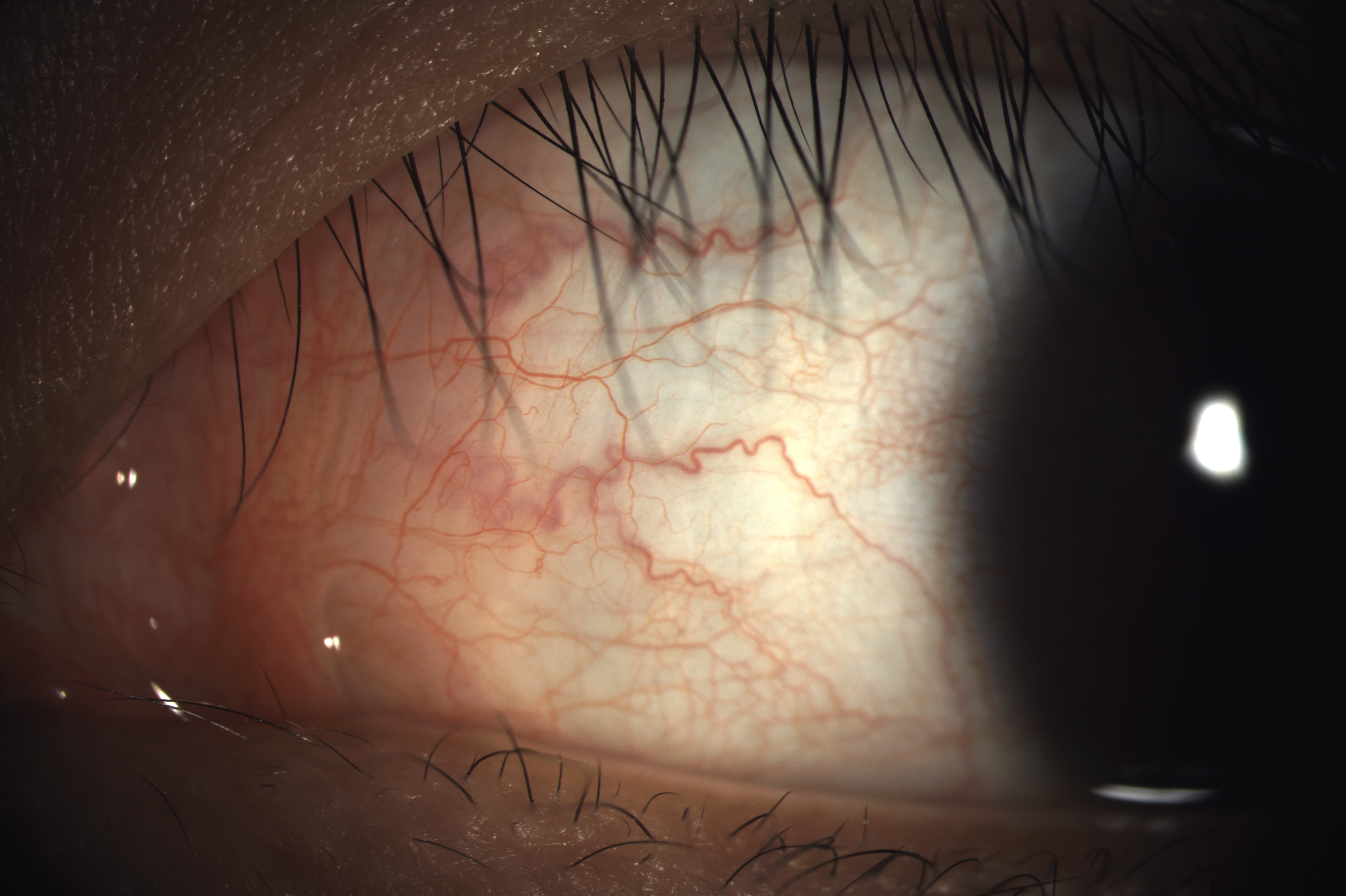 Analizador de Superficie Ocular DA-1