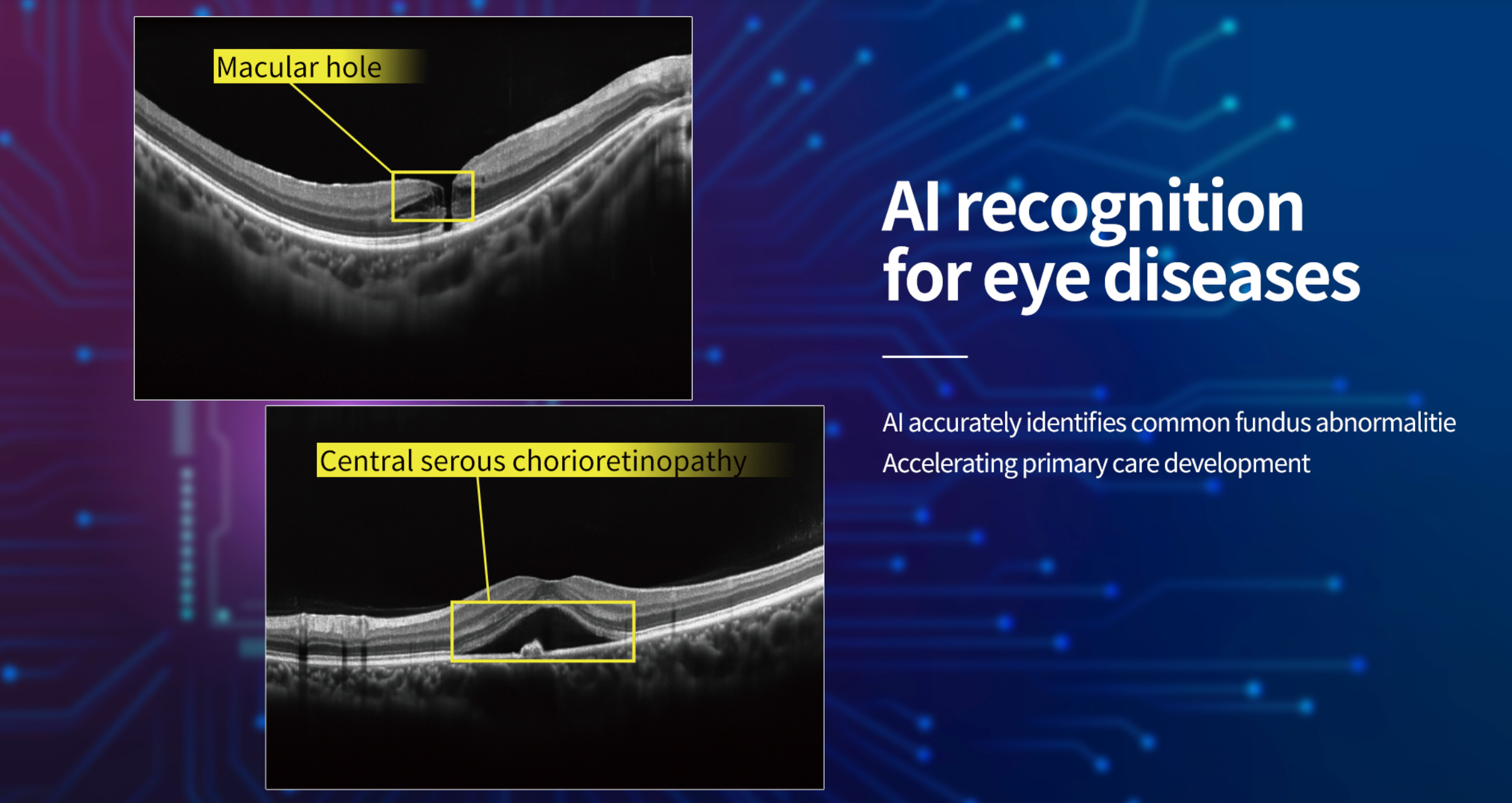 OCT Velite C-3000 OCT-ANGIO Alta Velocidad / Ultra Alta Resolución