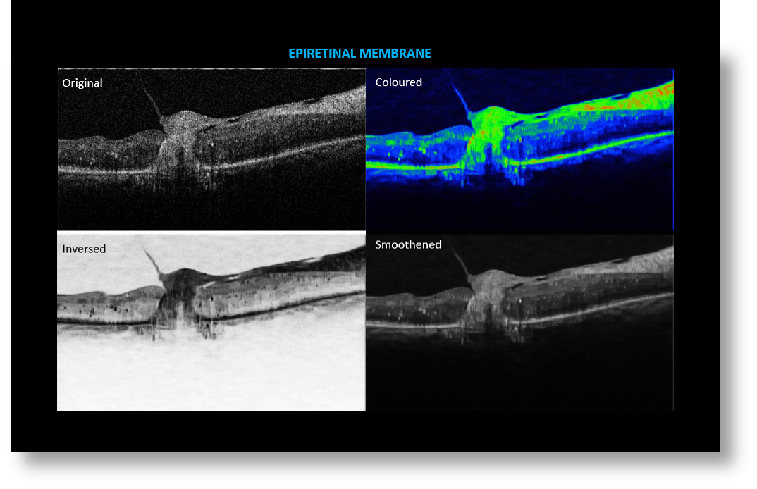 OCT Portátil IXANNER 7vn