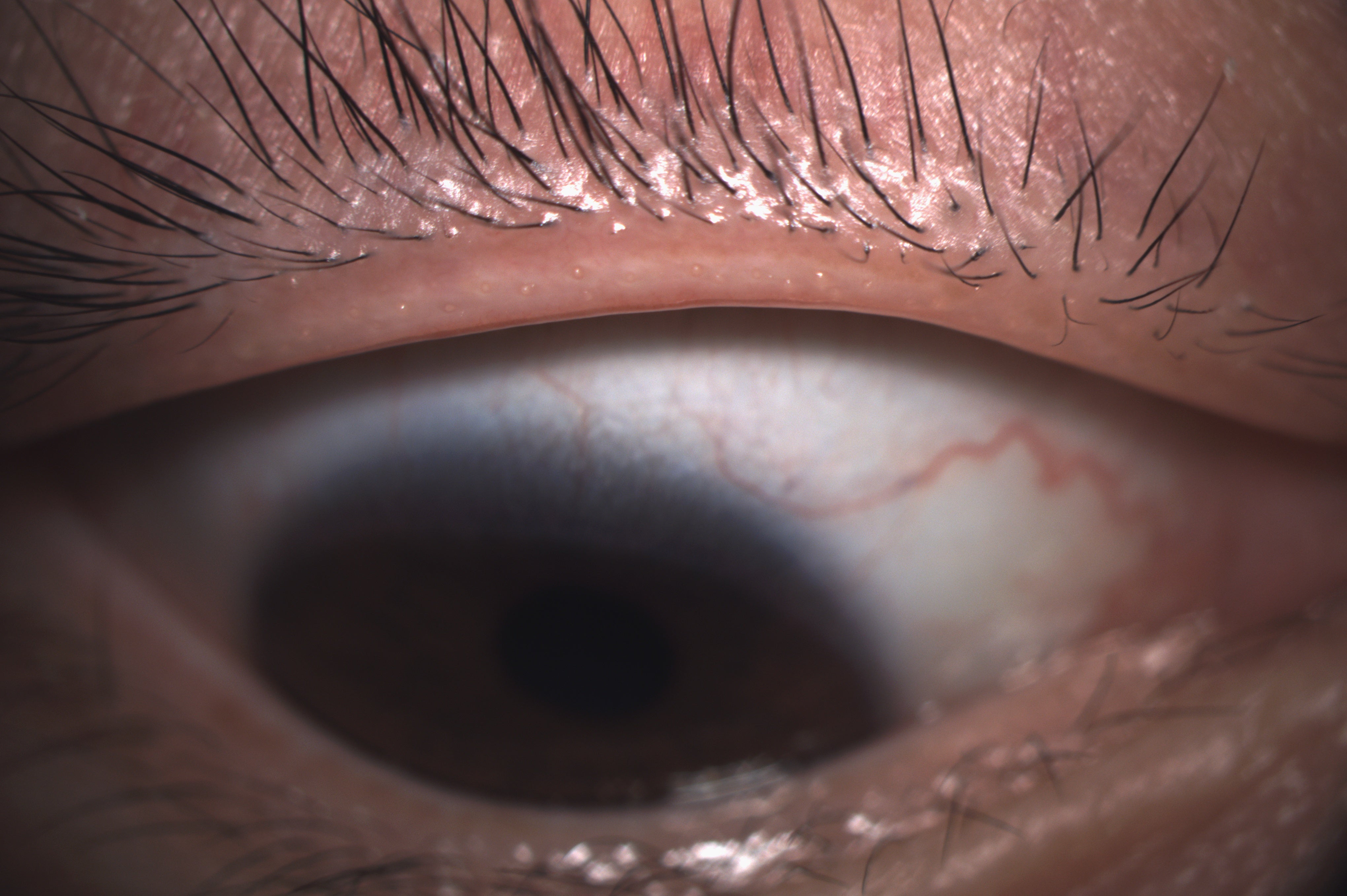 Analizador de Superficie Ocular DA-1