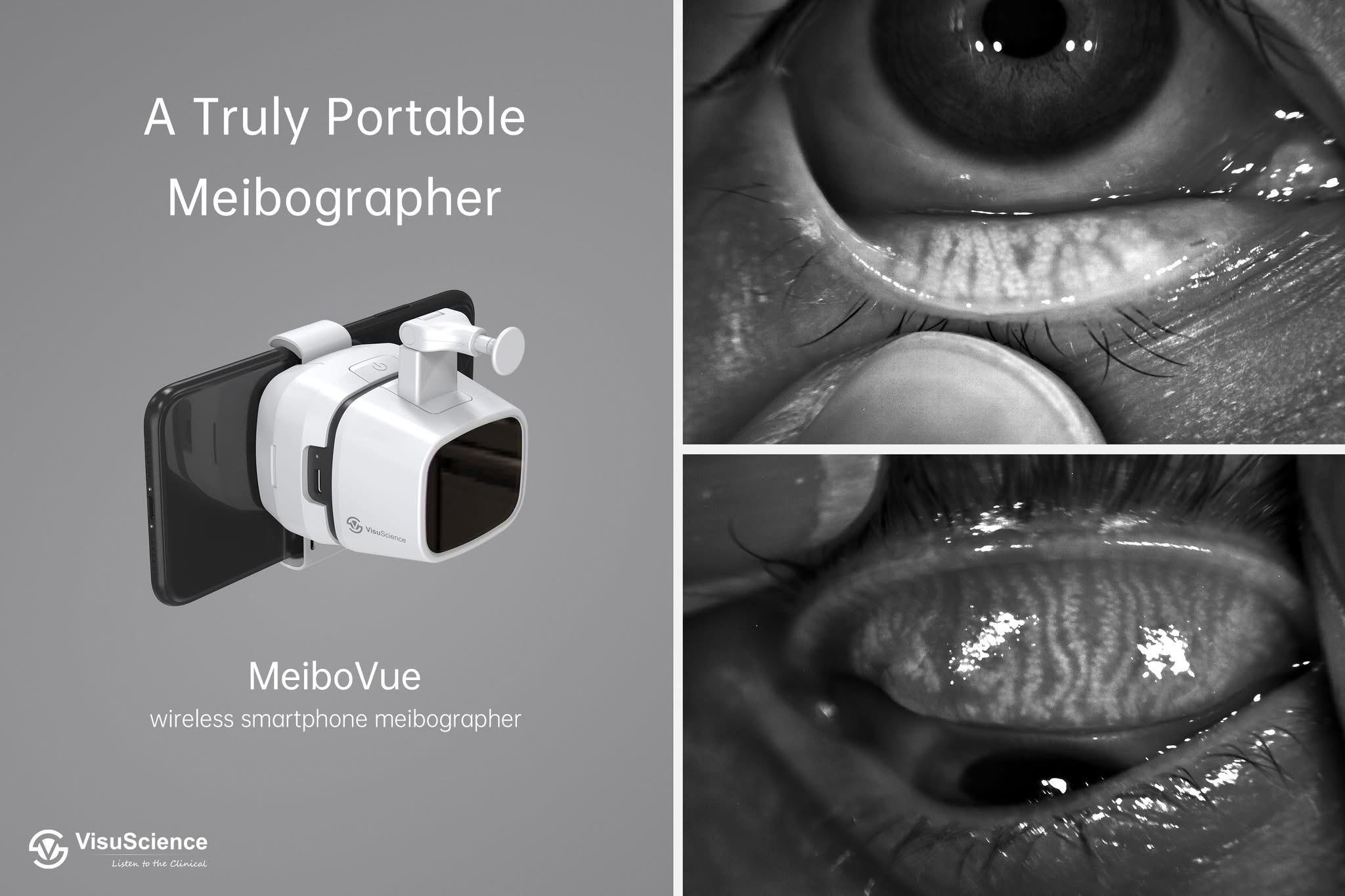 Meibógrafo Portátil MeiboVue VCM-100