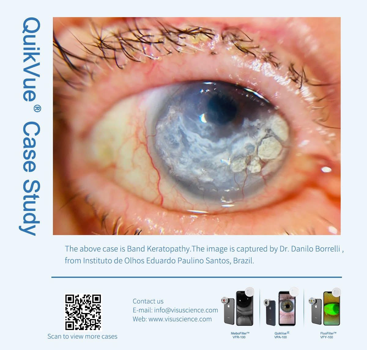 Adaptador de Imagen Ocular QuickVue Plus