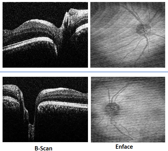 OCT Portátil IXANNER 7vn