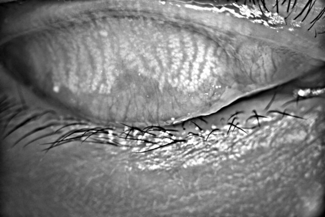 Analizador de Superficie Ocular DA-1