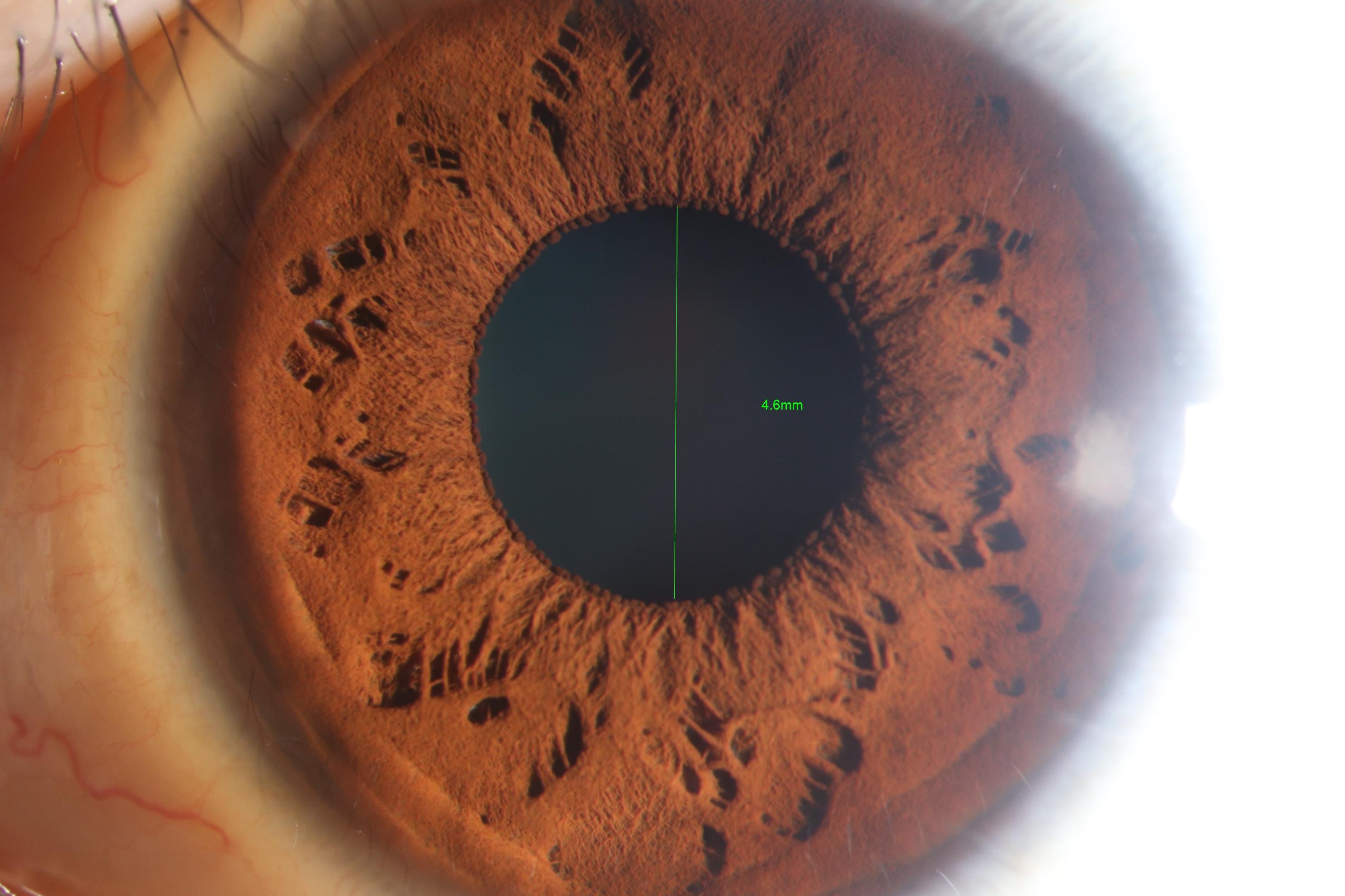 Lámpara de Hendidura Digital LS-5C + Módulo Ojo Seco
