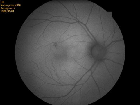 Cámara Retinal No Midriática RetiCam-5100 PRO (*Angio/AutoFluor)