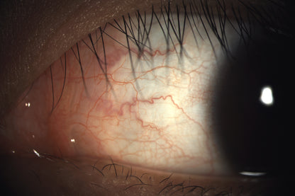 Analizador de Superficie Ocular DA-1