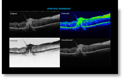 OCT Portátil IXANNER 7vn