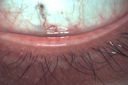 Analizador de Superficie Ocular Avanzado DA-3