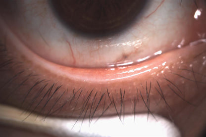 Analizador de Superficie Ocular DA-1