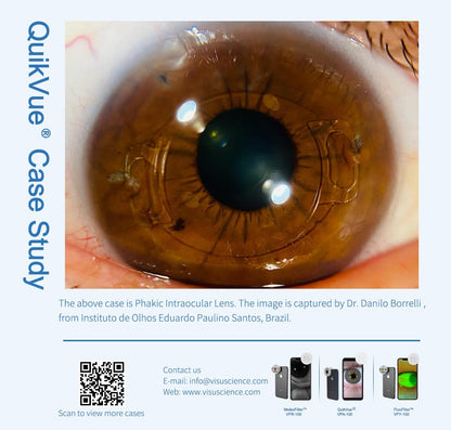 Adaptador de Imagen Ocular QuickVue Plus