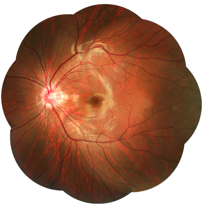 Cámara Retinal No Midriática + Angiográfo SK-650B