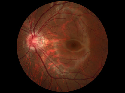 Cámara Retinal No Midriática + Angiográfo SK-650B