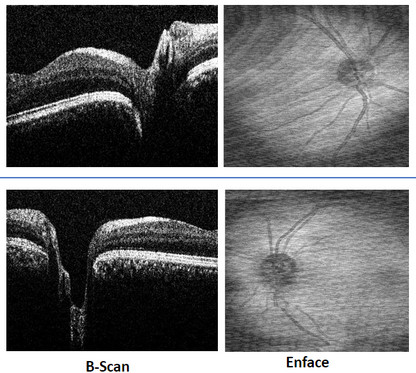 OCT Portátil IXANNER 7vn