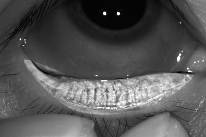 Analizador de Superficie Ocular Avanzado DA-3