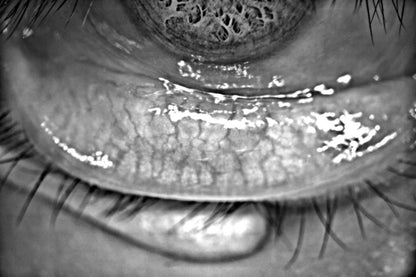 Analizador de Superficie Ocular DA-1