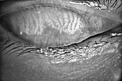 Analizador de Superficie Ocular DA-1