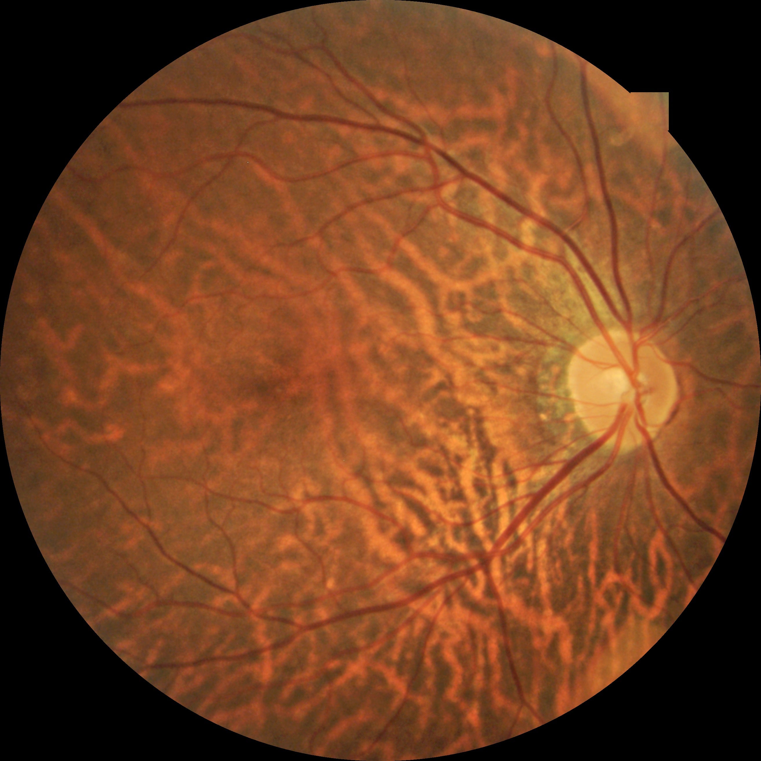 Cámara Retinal No Midriática Kestrel-300 (Disponible Demo Gratuita)