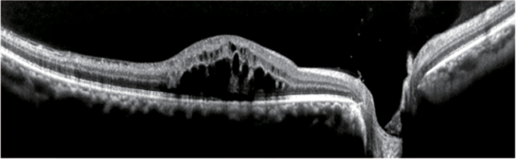 OCT Velite C-3000 OCT-ANGIO Alta Velocidad / Ultra Alta Resolución