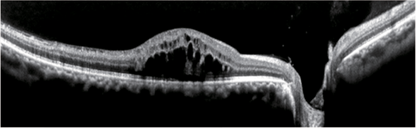 OCT Velite C-3000 OCT-ANGIO Alta Velocidad / Ultra Alta Resolución