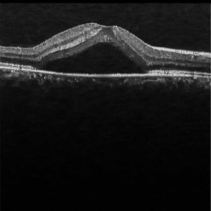 OCT Portátil IXANNER 7vn