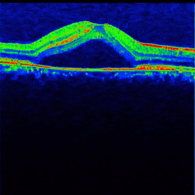OCT Portátil IXANNER 7vn