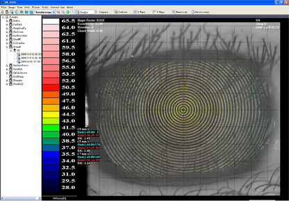Topógrafo Corneal CT-6000